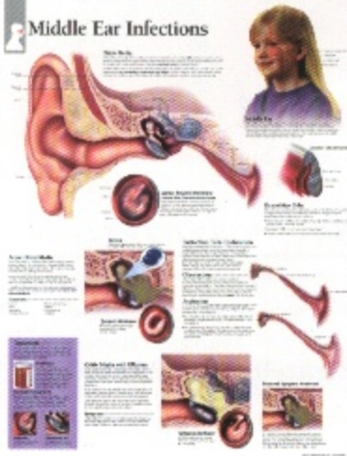 Book cover of: Middle Ear Infections Laminated Poster. By: Scientific Publishing