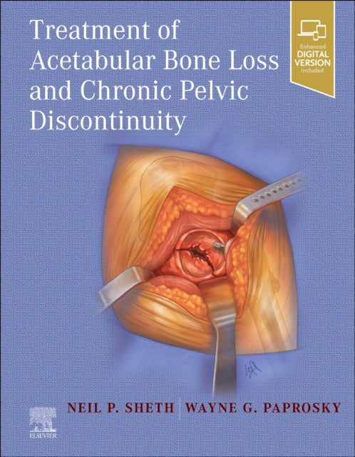 Book cover of: Treatment of Acetabular Bone Loss and Chronic Pelvic Discontinuity. By: Neil P. Sheth