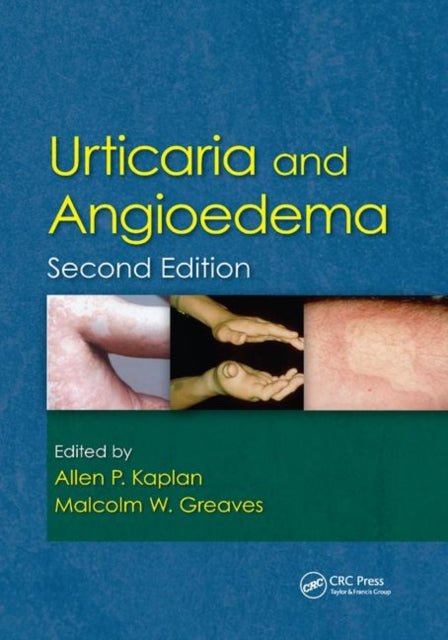 Book cover of: Urticaria and Angioedema. By: Allen Kaplan