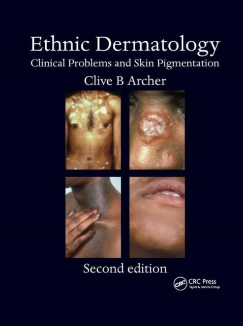 Book cover of: Ethnic Dermatology. By: Clive B. Archer