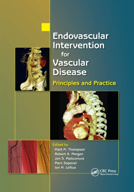 Book cover of: Endovascular Intervention for Vascular Disease