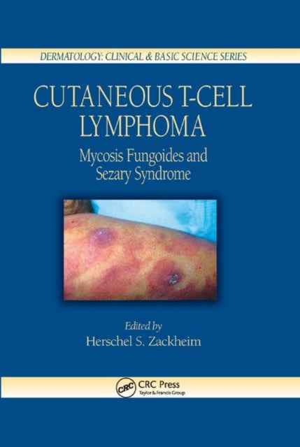 Book cover of: Cutaneous T-Cell Lymphoma. By: Herschel S. Zackheim