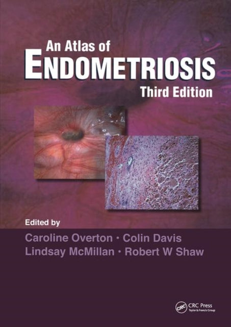 Book cover of: Atlas of Endometriosis. By: Caroline Overton