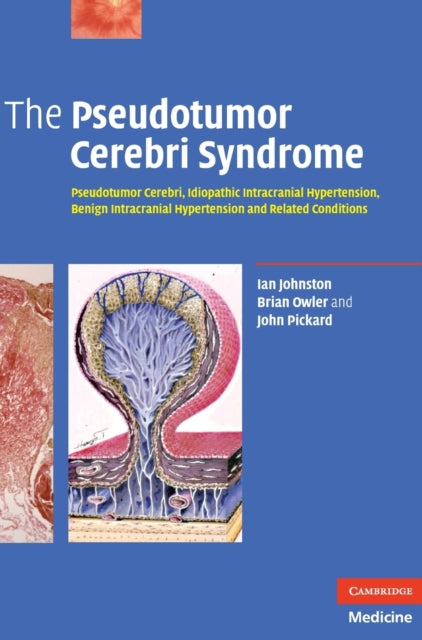 Book cover of: Pseudotumor Cerebri Syndrome. By: Ian Johnston
