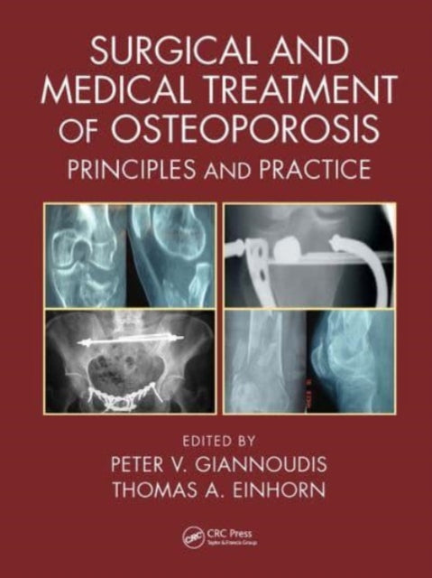 Book cover of: Surgical and Medical Treatment of Osteoporosis. By: Peter V. Giannoudis