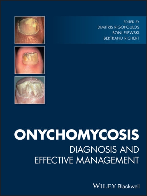 Book cover of: Onychomycosis. By: Dimitris Rigopoulos