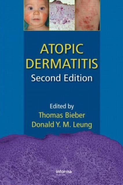 Book cover of: Atopic Dermatitis