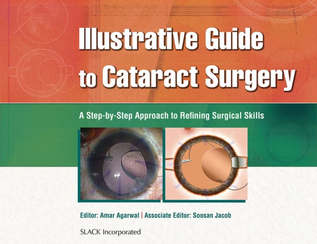 Book cover of: Illustrative Guide to Cataract Surgery. By: Amar Agarwal