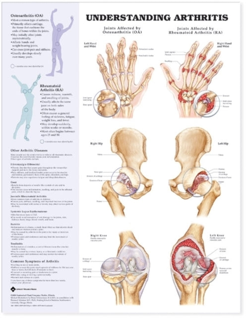 Book cover of: Understanding Arthritis Anatomical Chart