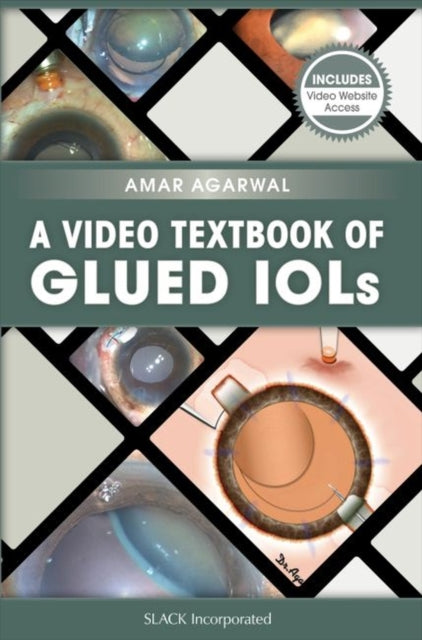 Book cover of: Video Textbook of Glued IOLs. By: Amar Agarwal