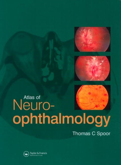 Book cover of: Atlas of Neuro-ophthalmology. By: Thomas C. Spoor