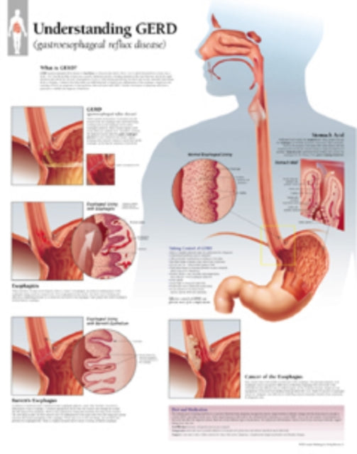 Book cover of: Understanding GERD (Gastroesophageal Reflux Disease) Laminated Poster. By: Scientific Publishing
