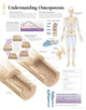 Book cover of: Understanding Osteoporosis Laminated Poster. By: Scientific Publishing