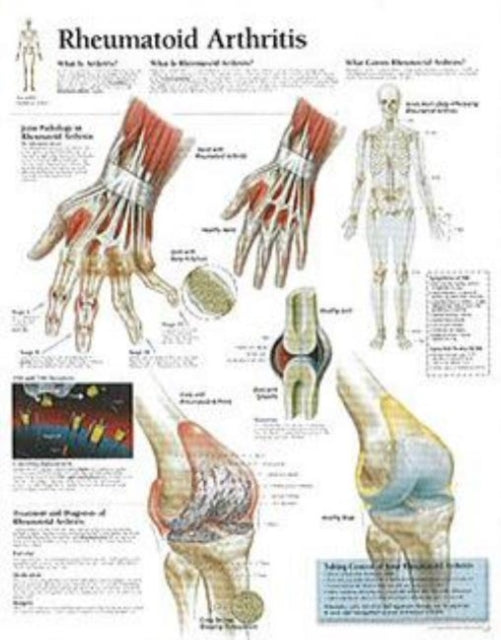 Book cover of: Rheumatoid Arthritis Paper Poster