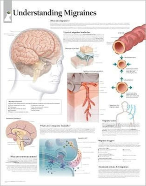 Book cover of: Understanding Migraines Paper Poster