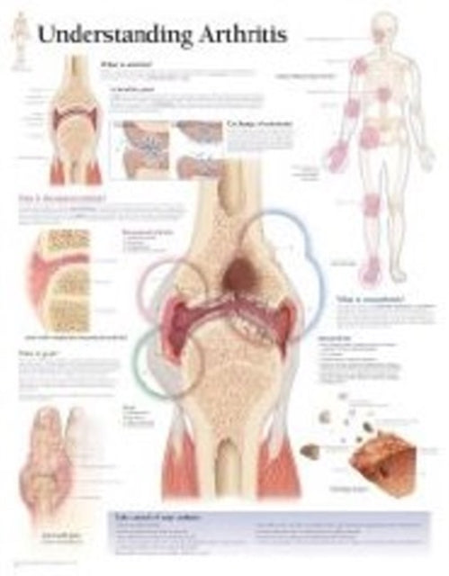 Book cover of: Understanding Arthritis Laminated Poster