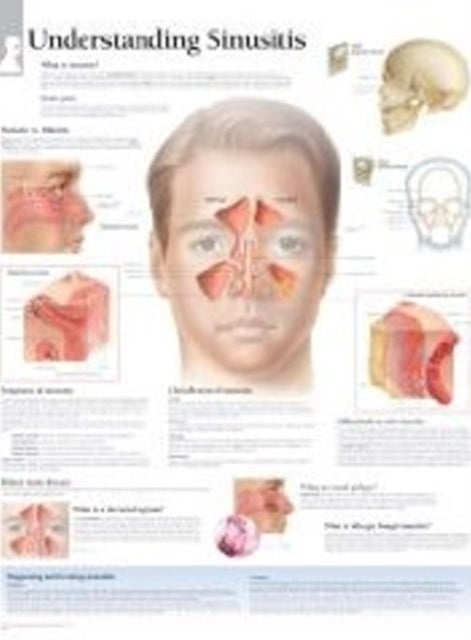 Book cover of: Understanding Sinusitis Paper Poster