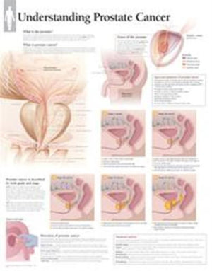 Understanding Prostate Cancer Laminated Poster