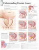 Book cover of: Understanding Prostate Cancer Laminated Poster