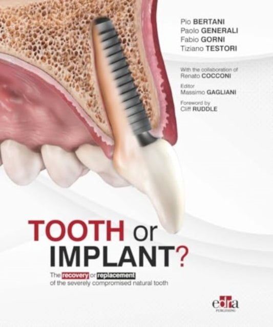 Book cover of: Tooth or Implant. By: Pio Bertani