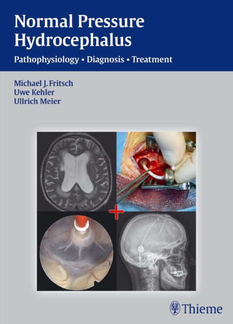 Book cover of: NPH - Normal Pressure Hydrocephalus. By: Michael J. Fritsch