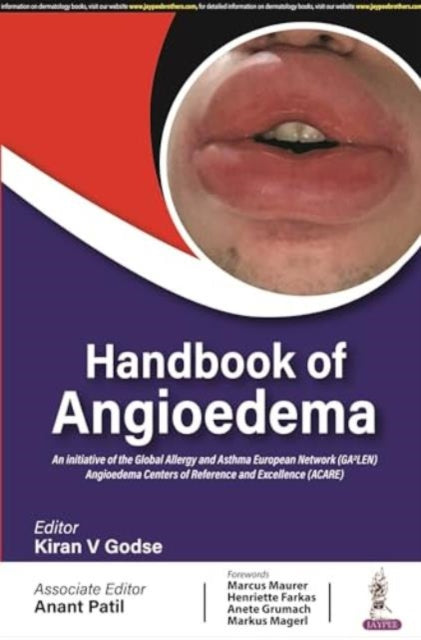 Book cover of: Handbook of Angioedema. By: Kiran V. Godse